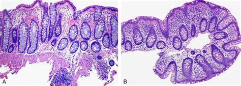 Sex Lies And Gastrointestinal Tract Biopsies A Review Of Advances In Anatomic Pathology