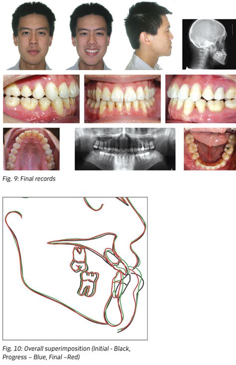 Class Iii Malocclusion Treated Non Surgically With Invisalign Mandibular Fixed Appliances