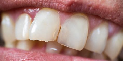 How To Fix Your Chipped Tooth Lister House Dental Centre