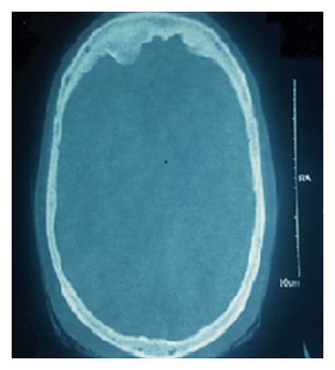 A Axial Cranial Computed Tomography Scan Illustrating The Bilateral