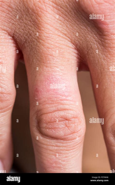 Psoriasis De La Piel Fotografías E Imágenes De Alta Resolución Alamy