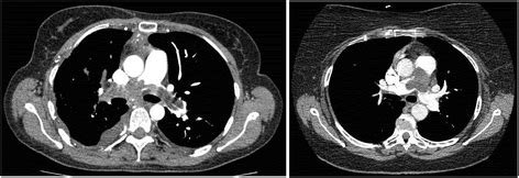 Presentation And Management Of Pulmonary Artery Sarcoma Clinical