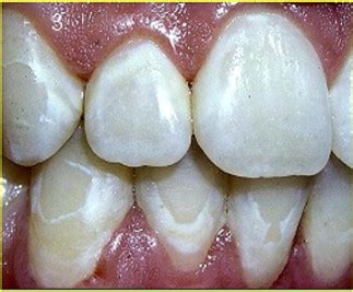 Do Orthodontic Braces Cause White Spots on Teeth? | Jorgensen Orthodontics - Affordable Care