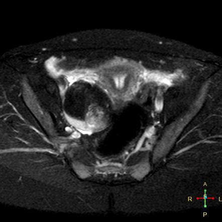 Ovarian Dermoid Cyst Radiology Case Radiopaedia Org