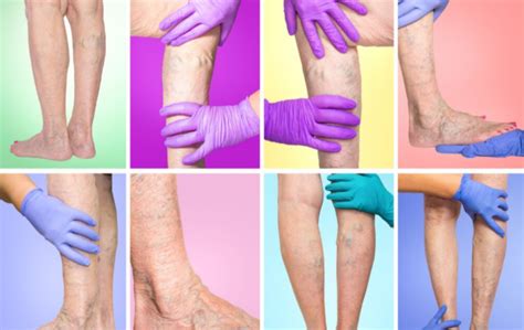 Are Varicose Veins Dangerous Usa Vein Clinics