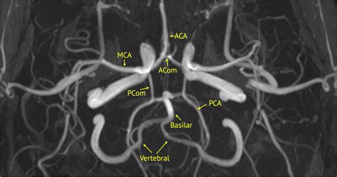 Intact Primary Arterial Collateral System Circle Of Willis Aca