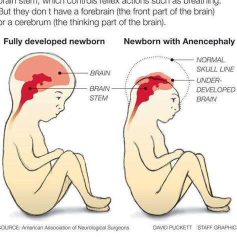 Pin on Anencephaly