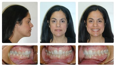 Orthodontic Before And After Photos Brodsky Orthodontics