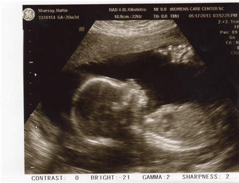 22 Week Ultrasound Girl