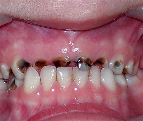 Tooth Decay Severe Early Childhood Caries An Integral Approach