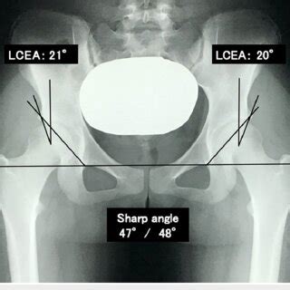 Radiograph, false profile view, shows bilateral acetabular dysplasia of ...