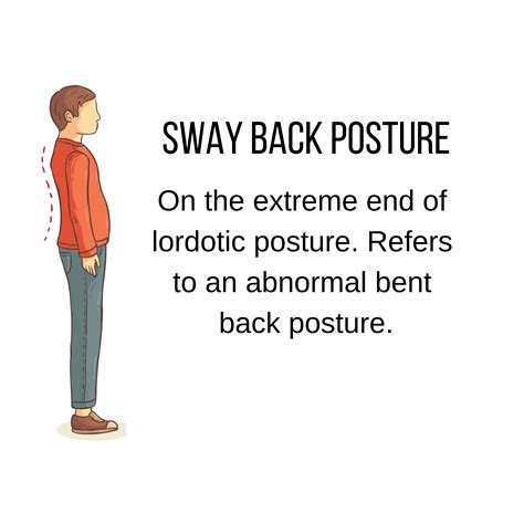 Swayback Posture How To Regain Balance Affinity Treatments