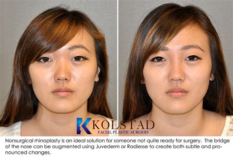 Radiesse Before And After Nose