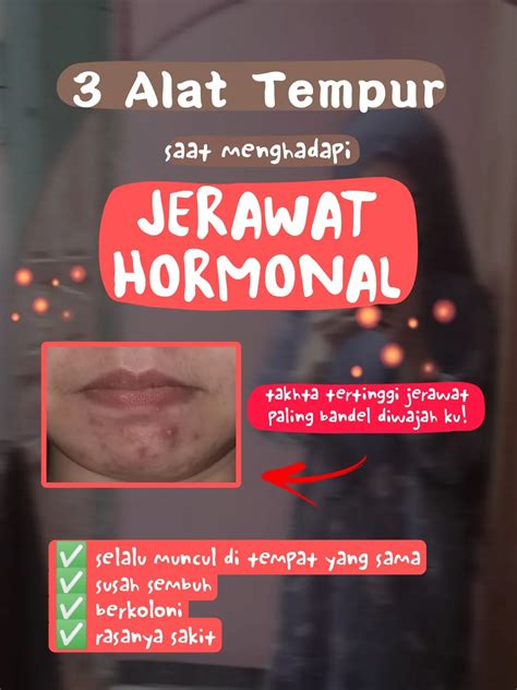 Alat Tempur Melawan Jerawat Hormonal Tips Galeri Diposting Oleh