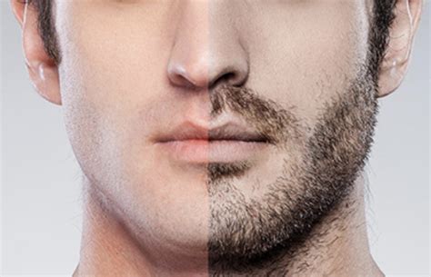 Beard Transplant Idealeste Haartransplantation Dhi Saphir Fue