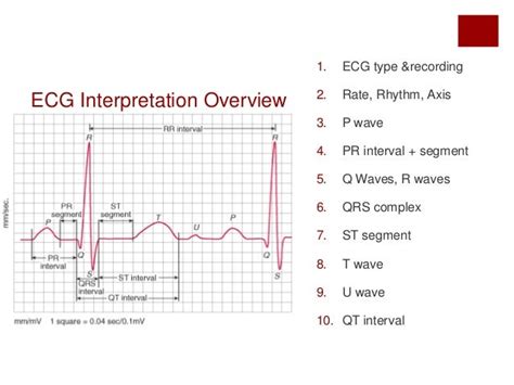 ECG interpretation