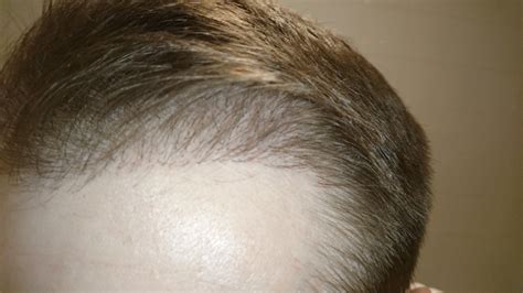 Fue Post Op Pictures 4 Months Hair Transplant Story