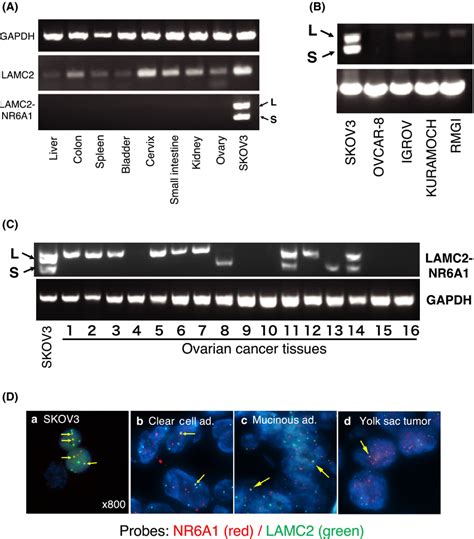 Expression Of Lamc2‐nr6a1 Fusion Transcripts In Human Ovarian Cancer Download Scientific