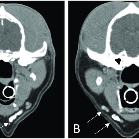 Sentinel Lymph Node Sln Detection On Indirect Computed Tomography