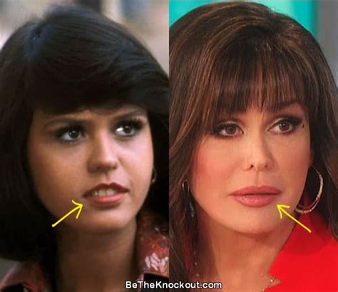 Marie Osmond Plastic Surgery Comparison Photos