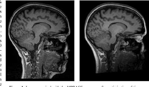 Figure 1 From Optimization Of The MPRAGE Sequence For Fully Automatic