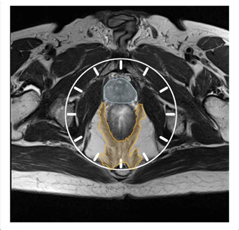 Visualizing The Axial Plane Of T2w Mri As The Face Of A Clock Orange