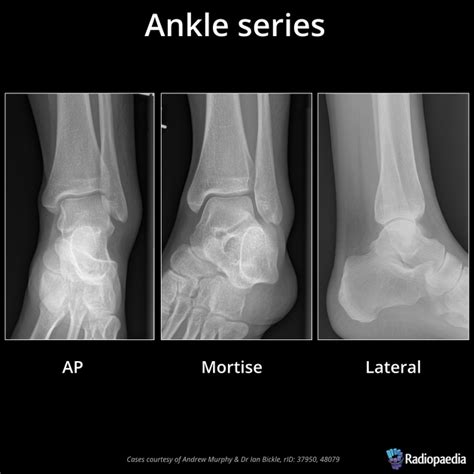 Fracture ankle? : r/xrays