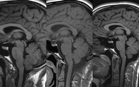 Pre Month And Months Post Chiari Decompression As The