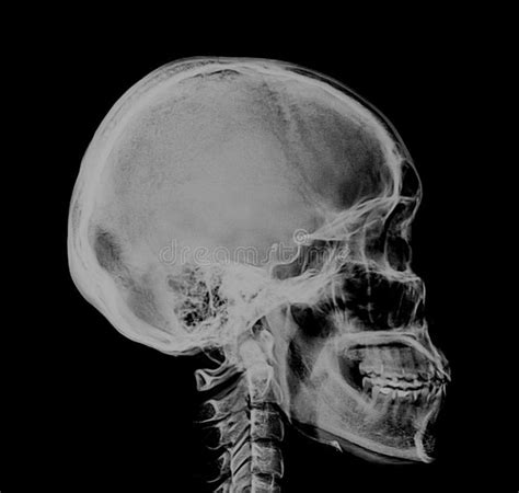 Human Skull Xray Negative Scan. A medical xray side view scan of the human head. You can see the ...