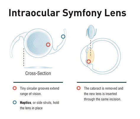 Intraocular Symfony Lens Center For Excellence In Eye Care