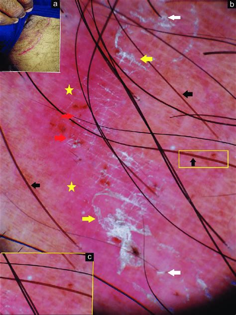 Clinical Image Of Dermatophytosis Of Shorter Duration A Dermoscopy