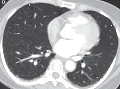 Scielo Brasil Incidental Detection Of Retroperitoneal