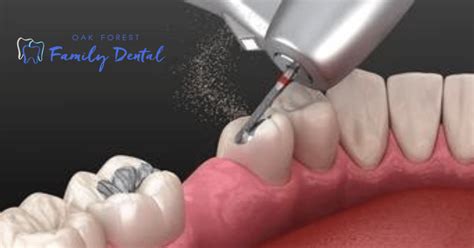 Know The Various Types Of Dental Fillings