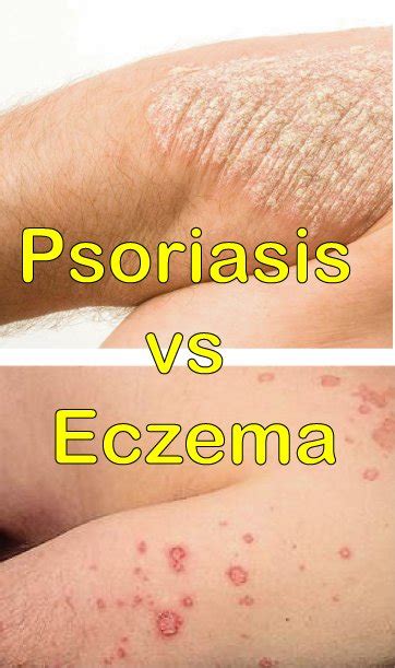 Psoriasis vs Eczema Based On 6 Parameters | Disfreeskin