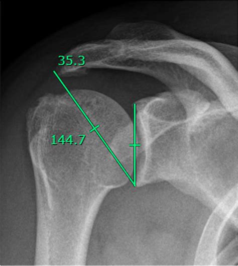 Measure Of The Critical Shoulder Angle In A True Anteroposterior Ap