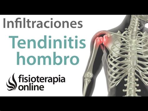 Lesi N De Hombro Tendinitis Del Supraespinoso Qu Es Causas