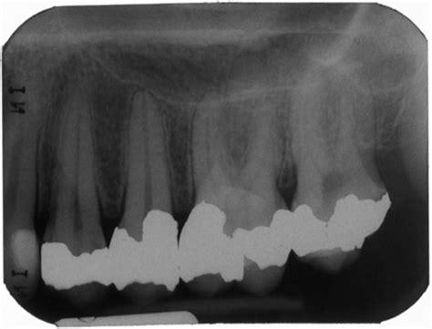 Anatomy Monday Floor Of The Nasal Cavity Maxilla Dr G S Toothpix