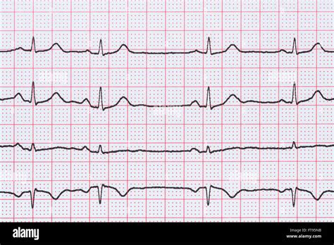 Sinus Heart Rhythm On Electrocardiogram Record Paper Showing Normal P