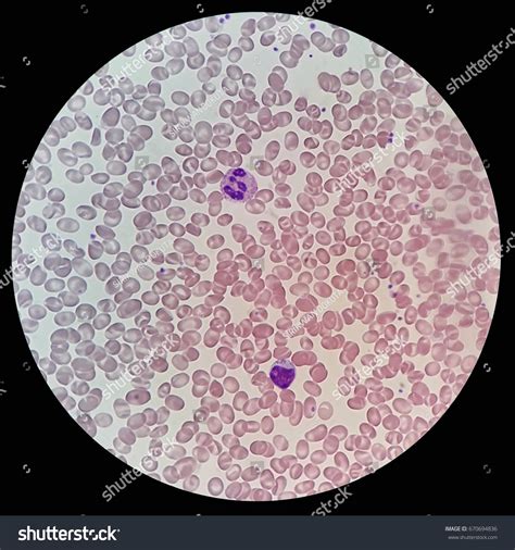 Human Blood Smear Abnormal Red Blood Stock Photo 670694836 | Shutterstock