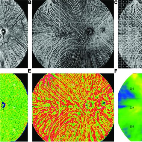 Representative Ultra Widefield Swept Source Optical Coherence