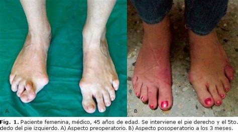 Aplicaci N De La Cirug A Percut Nea En El Tratamiento Del Hallux Valgus