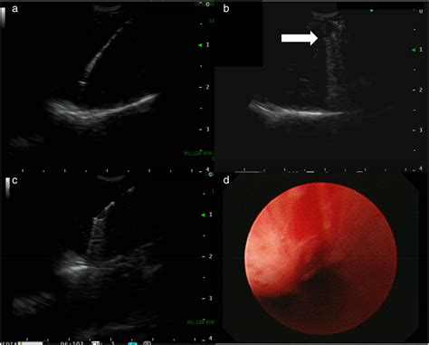 Endobronchial Ultrasound Ebus Images During Bronchoscopy And