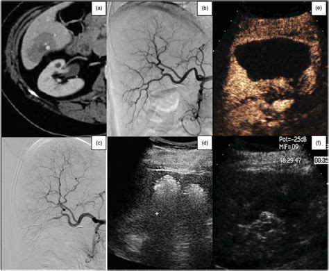 A Axial Ct Image Of A 74 Year Old Woman Showing A Breast Metastasis Download Scientific