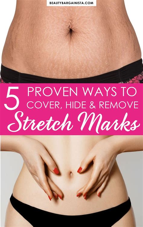 4 Ways To Remove Stretch Marks And 1 Way To Hide Them For Good Stretch