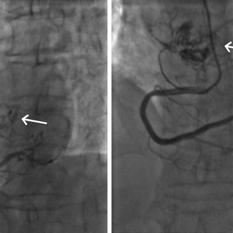 Characterization Of The Left Atrial Mass And Its Blood Supply On