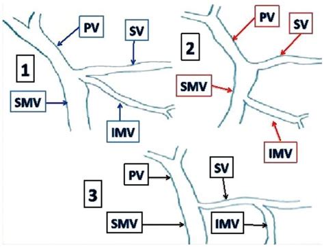 Inferior Mesenteric Vein Variations 1 Drain At The Confluence 2