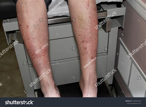 Dermatitis Herpetiformis Skin Rash Woman Nonceliac ภาพสต็อก 1339961483