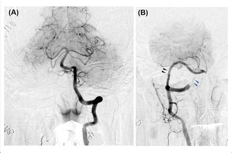 Postoperative Digital Subtraction Angiography Of Case A Left