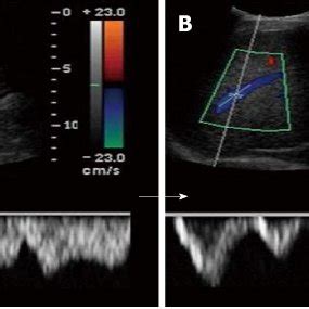 Doppler Ultrasonography Showing Change In The Hepatic Vein Waveform And