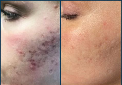 Skinpen Microneedling Before And After Photos In Tampa Fl